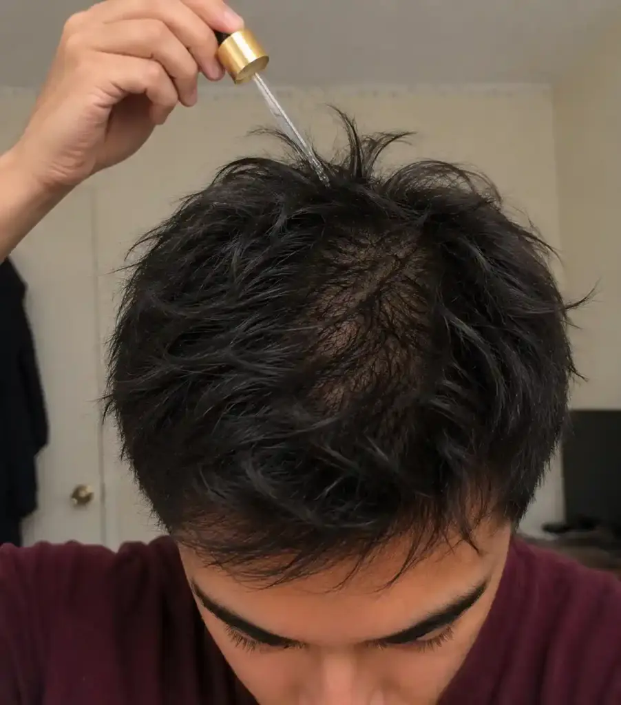 Applying Golden Tree Hair Boost Serum to a thinning scalp