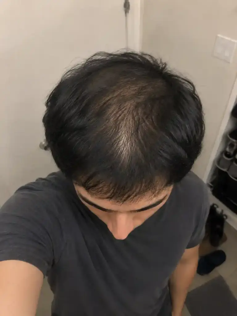 Hair thinning before using Golden Tree Hair Boost Serum