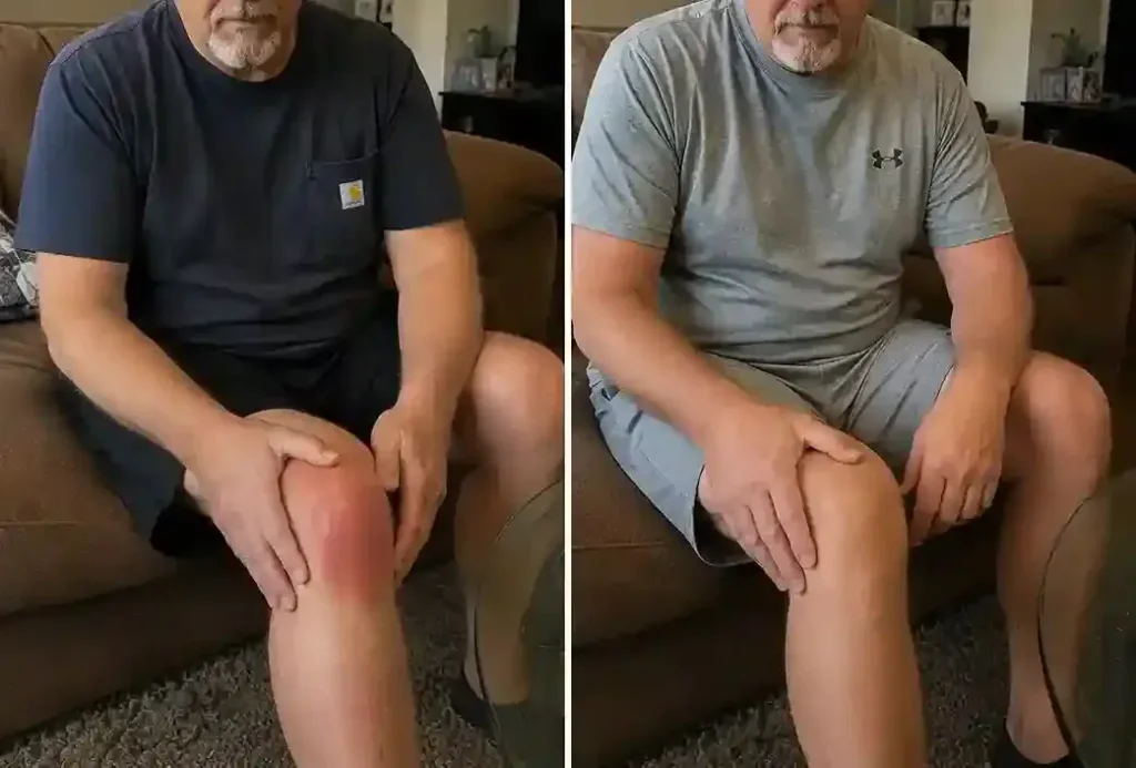 Arthryon haet relief Cream before and after