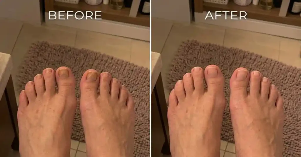 Metanail complex before and after